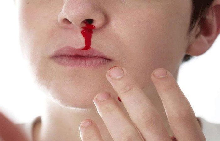Mơ thấy máu ở mũi có đáng sợ không?